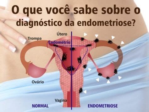 A diferença entre adenomiose e endometriose é que a adenomiose. endometriose sintomas causas | Endometriose, Exercicio ...
