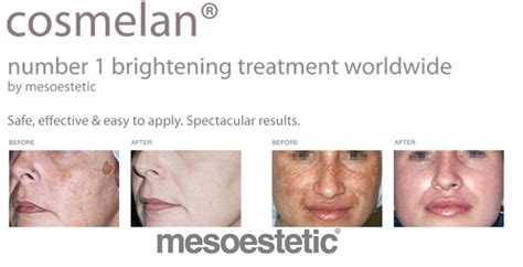 It's effective in diminishing the traction alopecia (caused by frequent pulling of the hair) and telogen effluvium (stress related excess hair shedding) can be treated by microneedling as well. Cosmelan