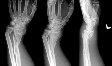 Impacted Fracture X Ray