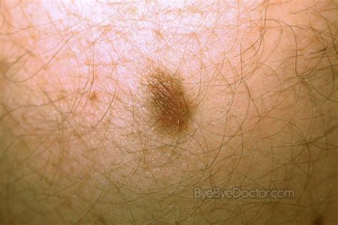 Dermatofibroma Pictures Causes Removal And Treatment Symptoms