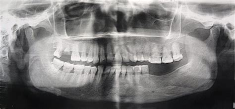 Opg X Ray Of A Periodontitis Patient Showing Severe Interdental Bone