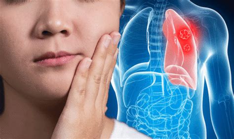 Lung Cancer Symptoms Signs Of Advanced Stages Include Superior Vena