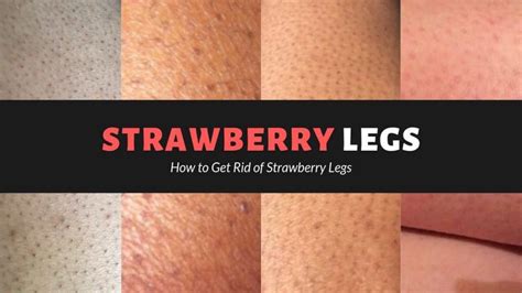 Get Rid Of Strawberry Legs With Home Remedies Recipes And Beauty Tips