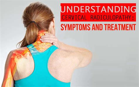 Symptoms Treatment Of Cervical Radiculopathy Copperjoint Dermatomes