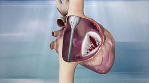 Innoventric Functional Tricuspid Valve Replacement Youtube