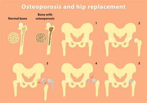Osteoporosis And Hip Replacement Vector Info 94936 Vector Art At Vecteezy