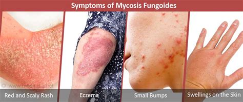 Mycosis Fungoides Causes Symptoms Diagnosis And Treatment