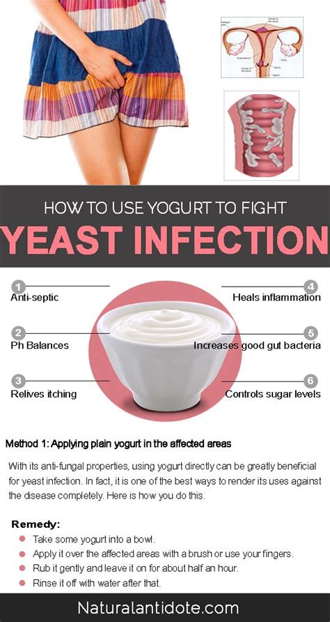 Natural Ways To Use Yogurt For Yeast Infections Yeast Infection Treatment Yeast Infection