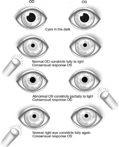Neuro Check Pupil Size Chart