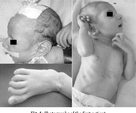 Figure 1 From Neonatal Marfan Syndrome Report Of Two Cases Semantic Scholar