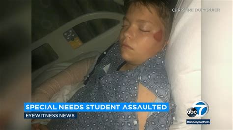 Mom Says Her Special Needs Son Had His Elbow Broken And Dislocated By A