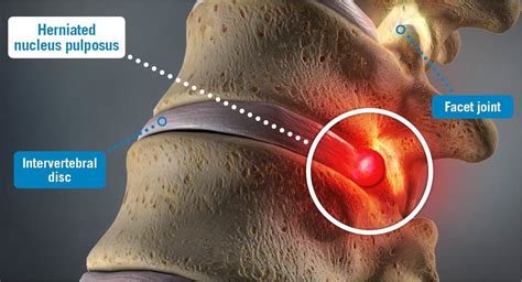 Herniated Nucleus Pulposus Usa Spine Care Laser Spine Surgery