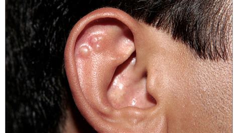 Skin Rash On Face And Behind Ears Severe Side Effects