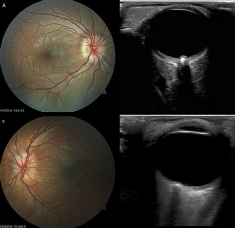 Choroidal Crescent Optic Nerve