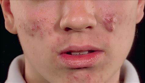 Adolescent Acne Vulgaris Current And Emerging Treatments The Lancet