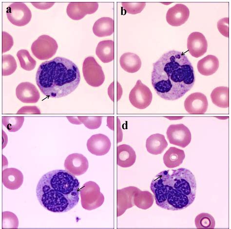 Revisiting Howell Jolly Body Like Cytoplasmic Inclusions In Neutrophils
