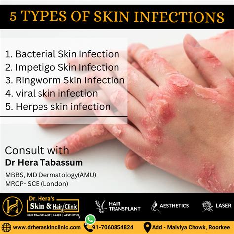 What Are The 5 Types Of Skin Infections Dermatologist In Roorkee