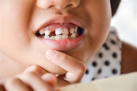When Should Your Childs Milk Teeth Be Extracted Will That Affect Your