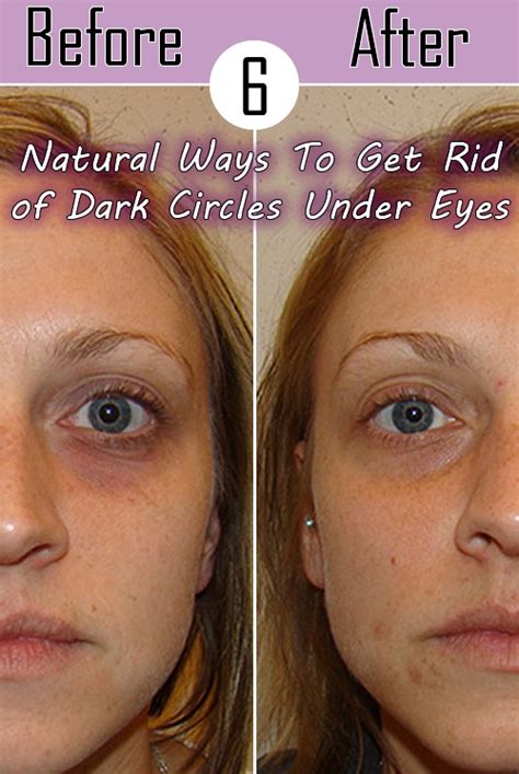 6 Natural Ways To Get Rid Of Dark Circles Under Eyes Fun And Fashion Blog