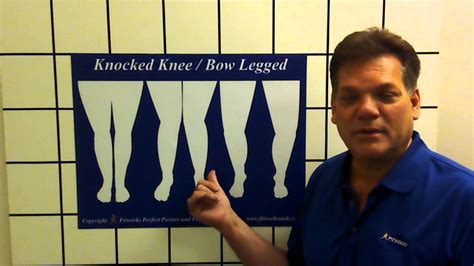 Knock Kneed Bow Legged Exercises Correct Posture Youtube