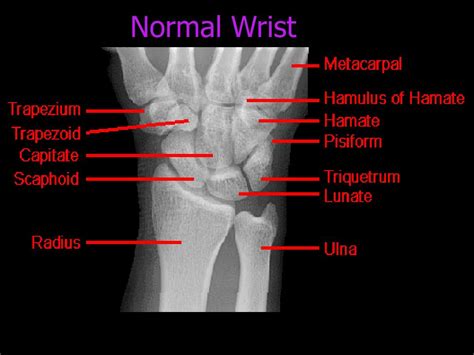 Ppt Normal X Ray Anatomy Powerpoint Presentation Free Download Id