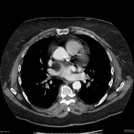 Lipomatous Hypertrophy Of The Interatrial Septum Radiology Case