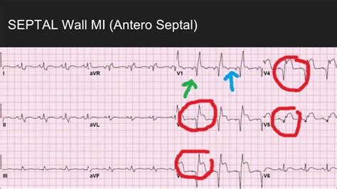 Septal Mi What You May Not Know Youtube