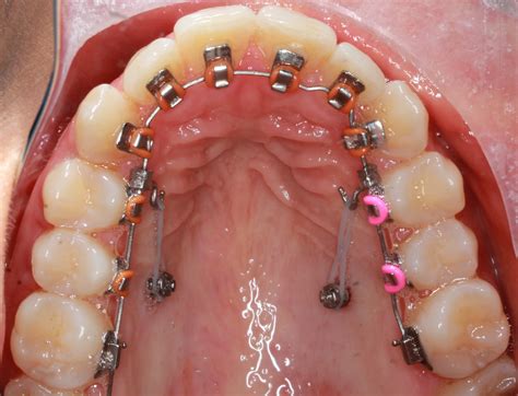 How Long Does It Take For Lingual Braces To Work Dr Wang S Experience