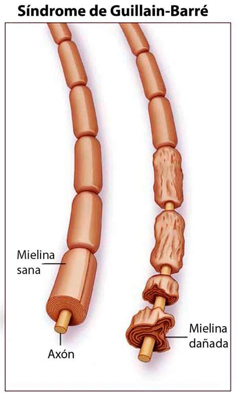 Provoca debilidad muscular, pérdida de reflejos y . Guillain Barré - Fisioterapia Neurológica