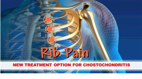 New Treatment For Costochondritis Thoracic Spine Series My Xxx Hot Girl