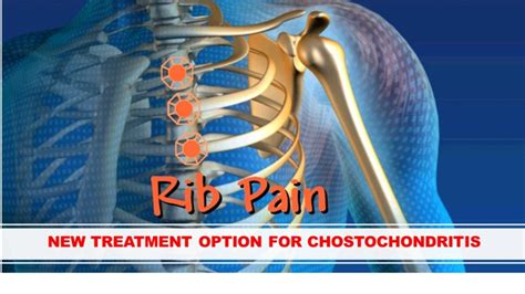 New Treatment For Costochondritis Thoracic Spine Series My XXX Hot Girl