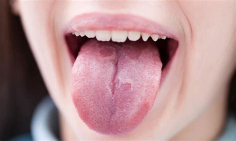 Brushing your teeth at least twice daily, and using mouthwash to rid the mouth of harmful bacteria. Bumps on the Tongue: Causes, Picture, Symptoms and Treatment