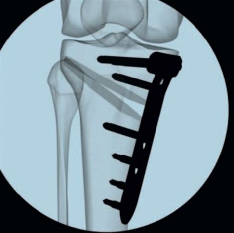 Knee — Tibial Osteotomy Avalon Orthopaedic