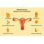 What Is Uterine Fibroids Causes Symptoms And Types Of The Benign Tumors