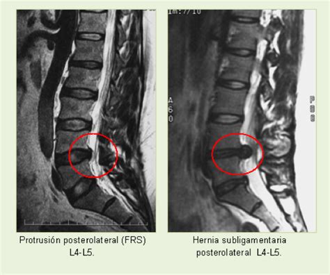 Protusiones Y Hernias Discales QuÉ Son Y CuÁles Son Sus SÍntomas