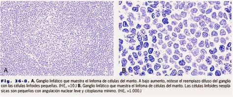 Fichero Hematologia Linfoma De Células Del Manto