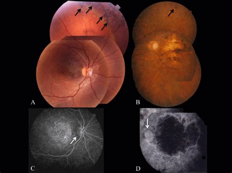 Fundus Photographs A B With Corresponding Fa Images C D Of 2