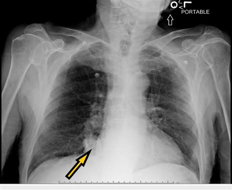 Chest X Ray Showing Focal Consolidation In The Medial Right Lung Base