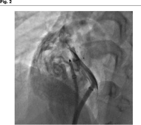 Figure 2 From Ice Guided Patent Foramen Ovale Pfo Closure With