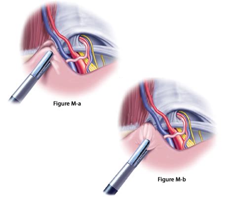 Laparoscopic Hernia Surgery Mesh PDF Laparoscopic Hernia Repair