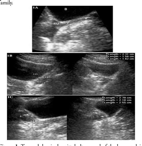 Mullerian Agenesis Ultrasound