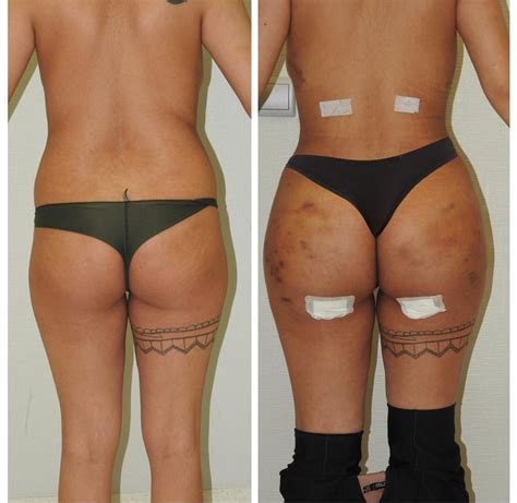 ≡ 5 Countries To Get Affordable Brazilian Butt Lift — Compare Prices