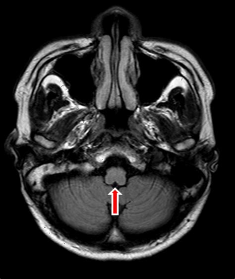 Magnetic Resonance Imaging Of The Brain Showed Atrophy Of The Brainstem