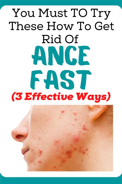 How To Get Rid Of Acne Fast 3 Effective Ways World Of Health