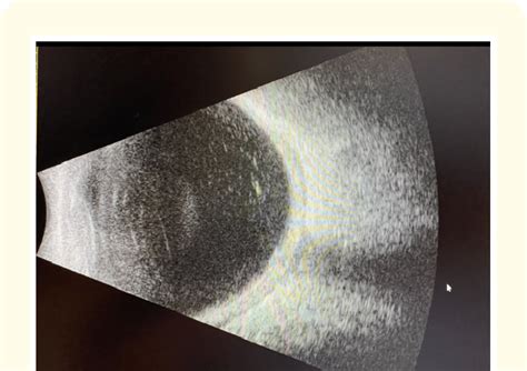 Ocular Ultrasound Of The Left Eye Showing Moderate Vitreous Opacities