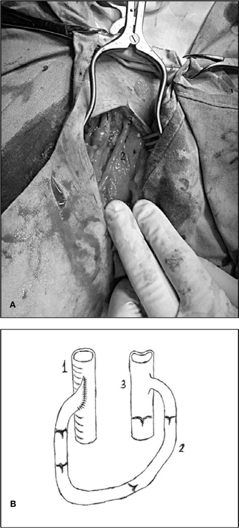 Figure 1 From Saphenous Vein Transposition For Arteriovenous Fistula