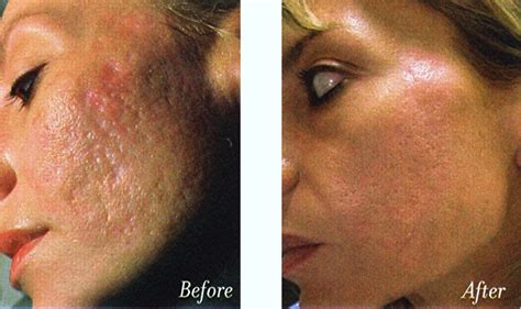 best treatment for acne scars and large pores acne scars treatment before and after