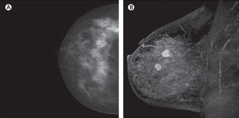 Mri For Breast Cancer Screening Diagnosis And Treatment The Lancet