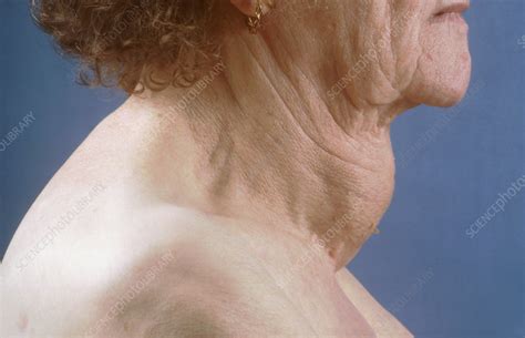 Goiter And Malignant Node Stock Image C0366336 Science Photo Library