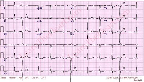 Premature Ventricular Contractions Or Pvcs Ecg Example 1